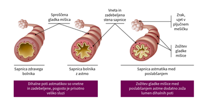 Patofiziologija astme